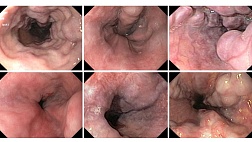 Классификация варикозного расширения вен пищевода по размерам МСТ 3.0